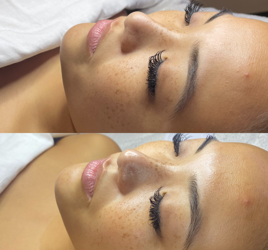 Hydrafacial in Spring, TX