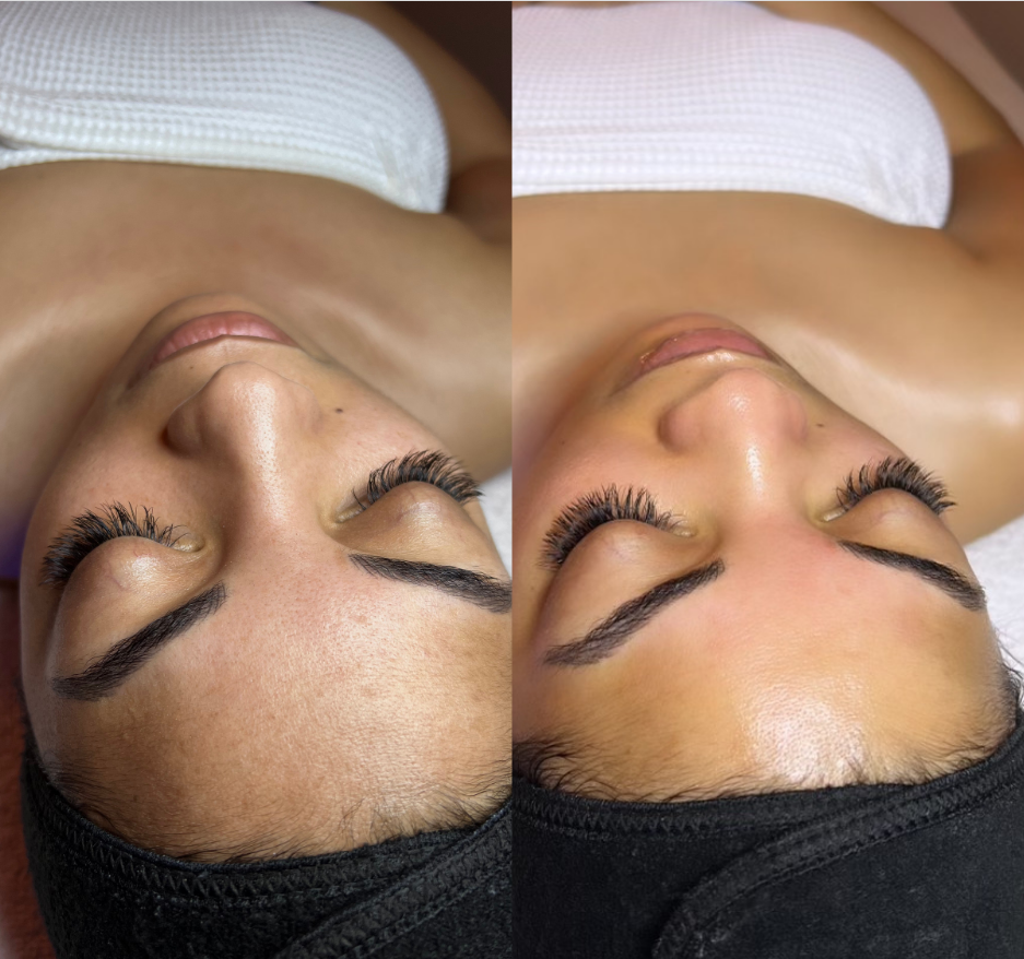 Best hydrafacial in Spring TX