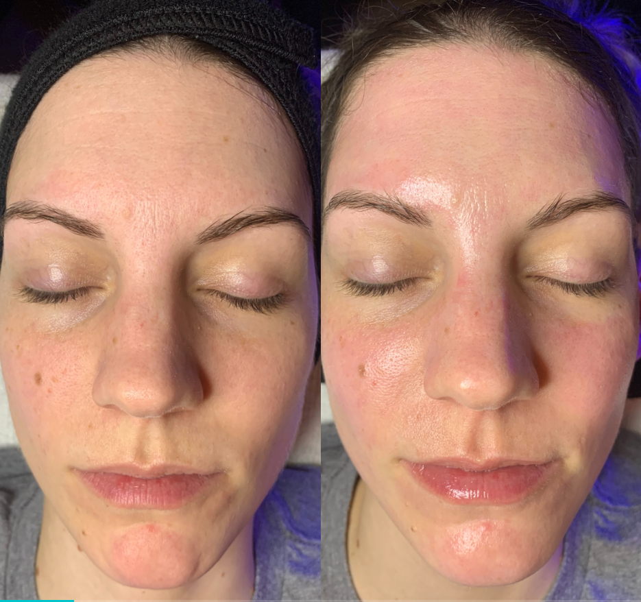 VI chemical Peel in Spring, TX