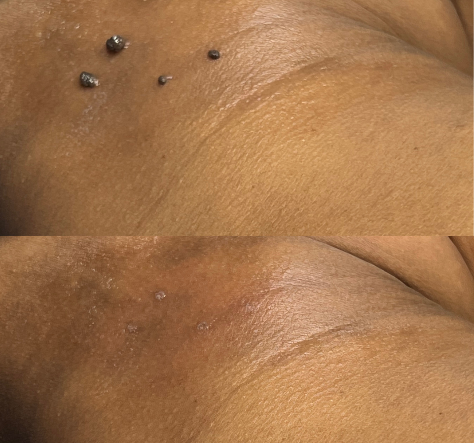 Skin tag removal in Spring, TX