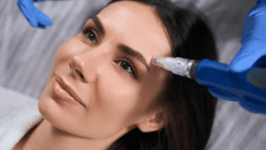 SkinPen Microneedling for Collagen Production