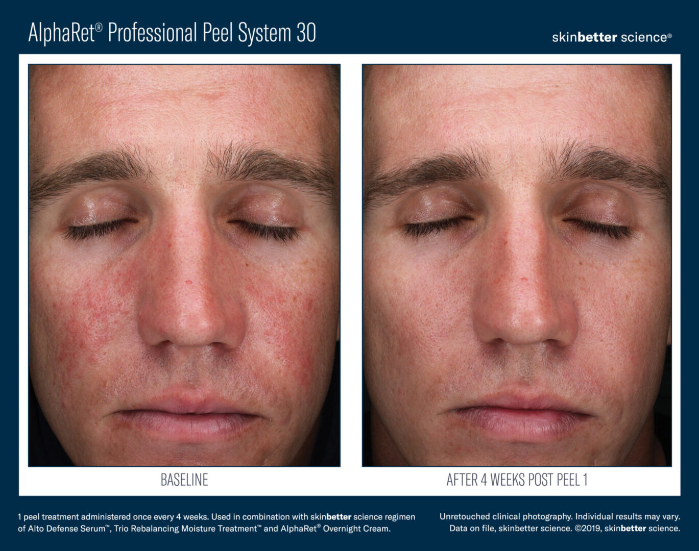 Chemical Peel for Men near me