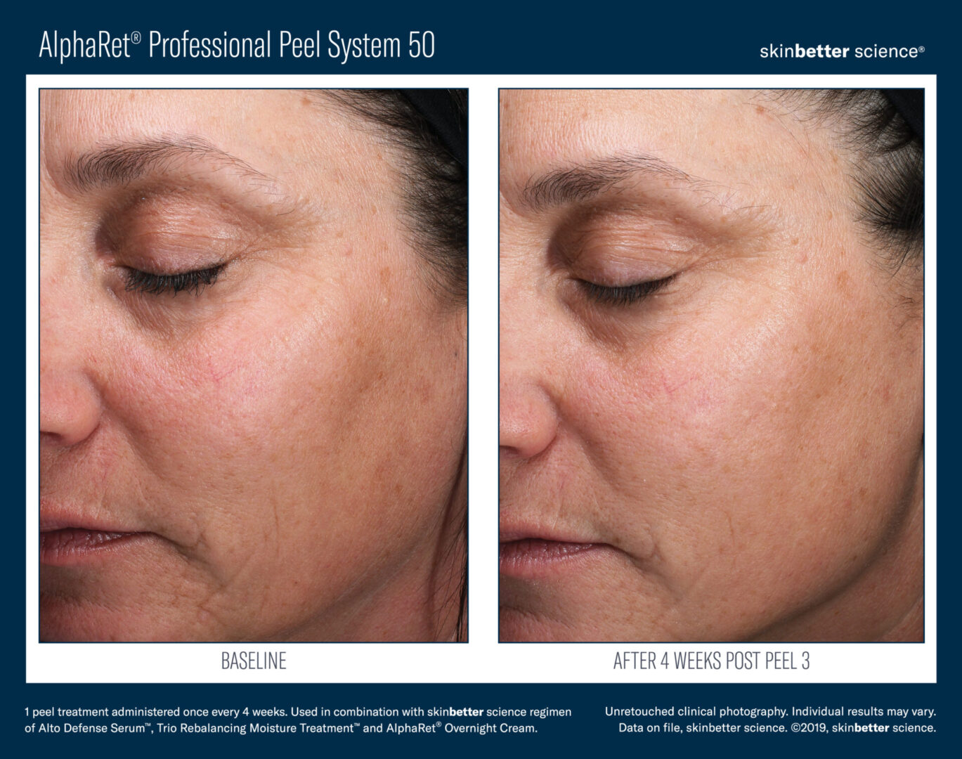 Professional Chemical Peel in Houston, TX